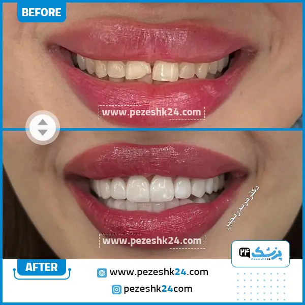 قبل و بعد کامپوزیت دندان دکتر مریم رنجبر شیراز