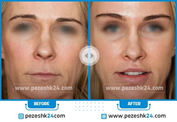 قبل و بعد لیفت لب در رشت