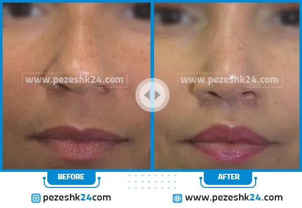 قبل و بعد از لیفت لب در رشت