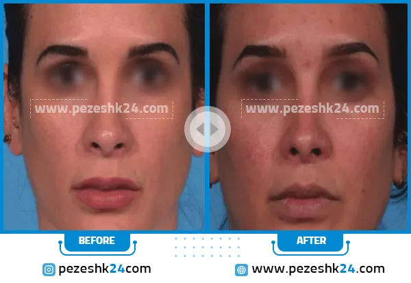 قبل و بعد سانترال لب در رشت