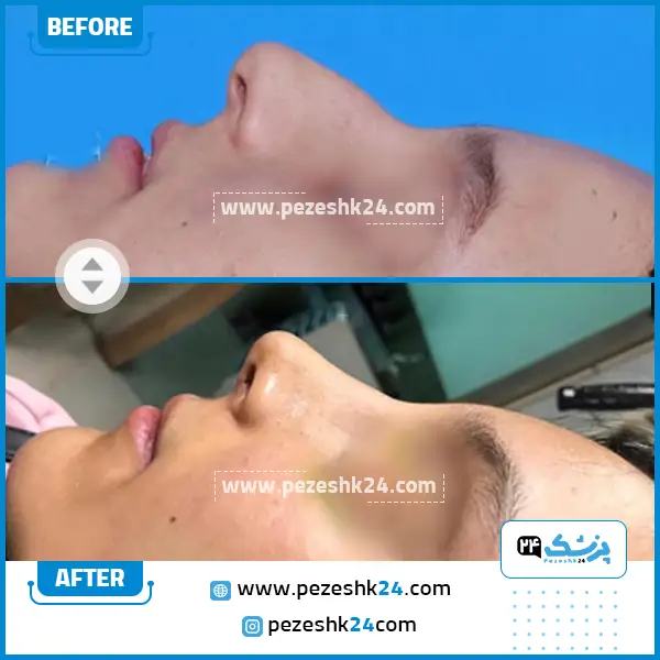 قبل و بعد عمل بینی دکتر اکبری قزوین