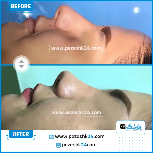 قبل و بعد رینوپلاستی دکتر اکبری در قزوین