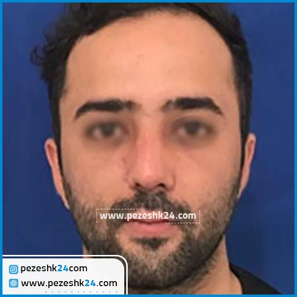 نمونه عمل بینی دکتر داوود اکبری