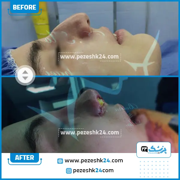 قبل و بعد رینوپلاستی دکتر بقایی قزوین