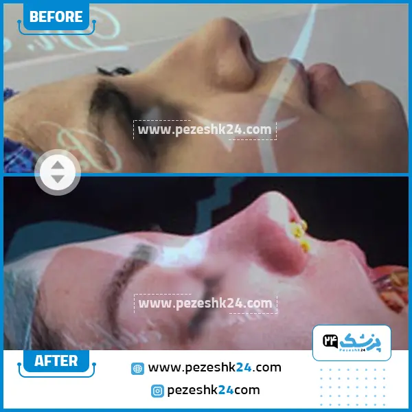 قبل و بعد عمل بینی دکتر بقایی قزوین