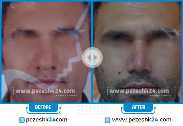 قبل و بعد جراحی بینی دکتر بقایی قزوین