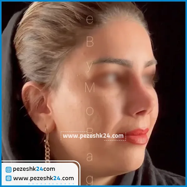 نمونه جراحی بینی دکتر بقایی قزوین