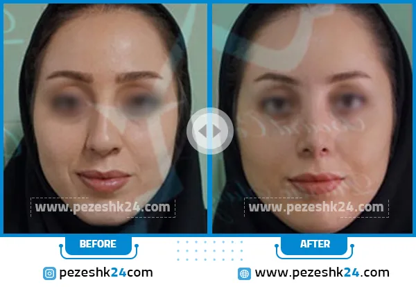 قبل و بعد رینوپلاستی دکتر محمد بقایی