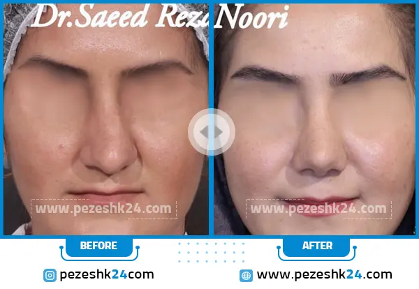 قبل و بعد جراحی بینی دکتر نوری قزوین