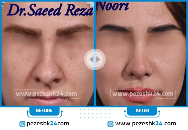 قبل و بعد عمل بینی دکتر سعیدرضا نوری