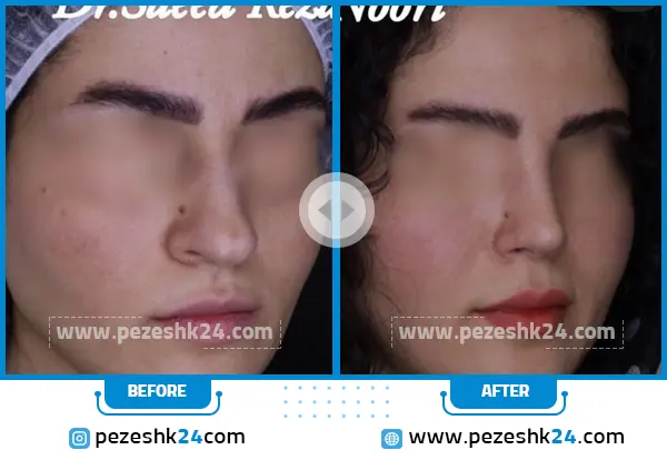 قبل و بعد عمل جراحی بینی دکتر نوری