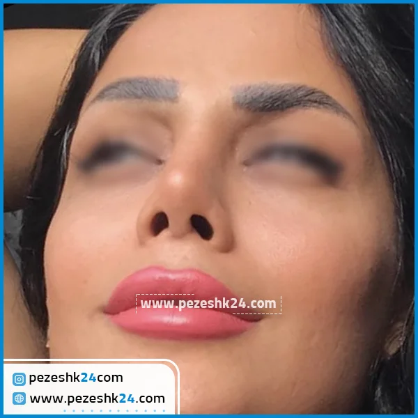 نمونه جراحی بینی دکتر نوری در قزوین