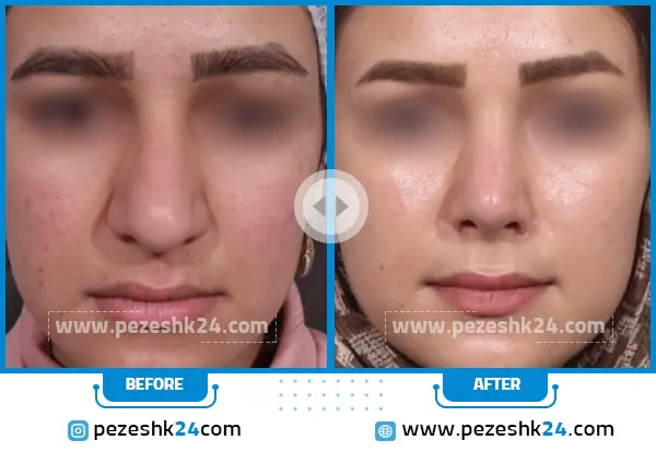 قبل و بعد رینوپلاستی دکتر نوری