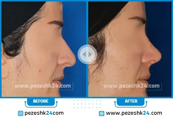 نمونه عمل بینی دکتر صفری قزوین