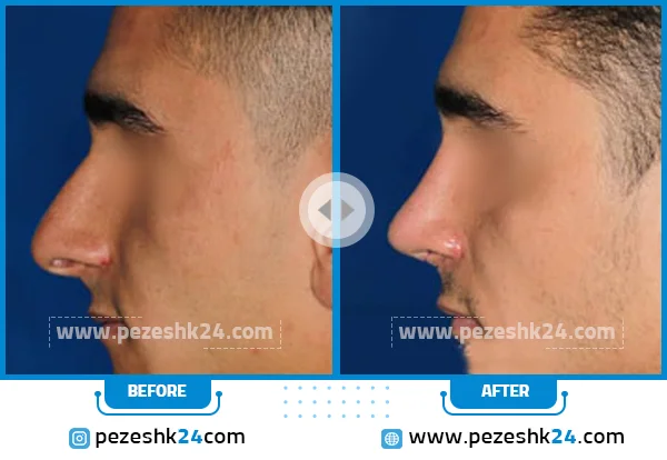 جراحی بینی دکتر صفری در قزوین