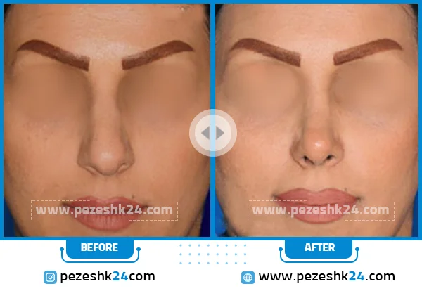 نمونه عمل بینی دکتر صفری در قزوین