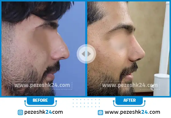 قبل و بعد جراحی بینی دکتر واردی