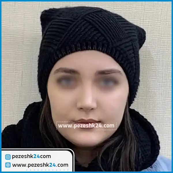 نمونه عمل بینی دکتر پیام واردی