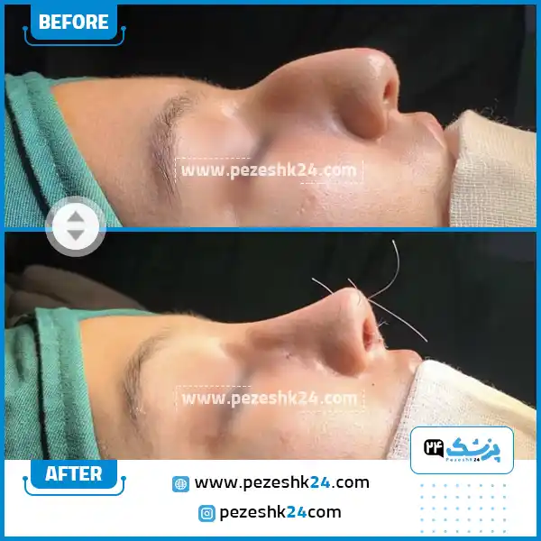 قبل و بعد عمل بینی دکتر واردی قزوین