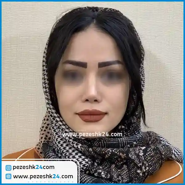 نمونه جراحی بینی دکتر واردی در قزوین