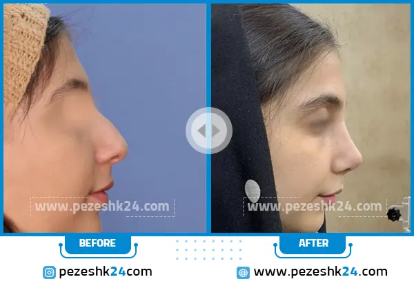 قبل و بعد رینوپلاستی دکتر واردی قزوین