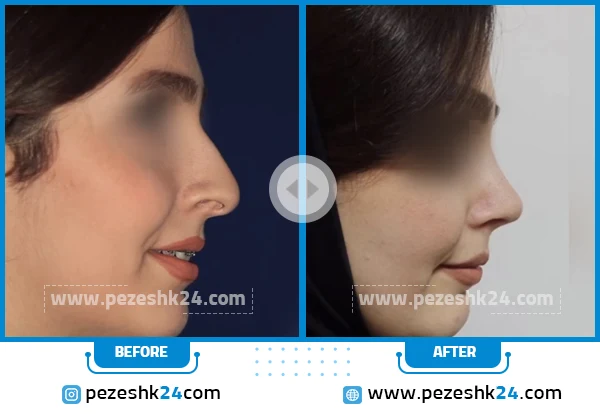 قبل و بعد جراحی بینی دکتر توکلی قزوین