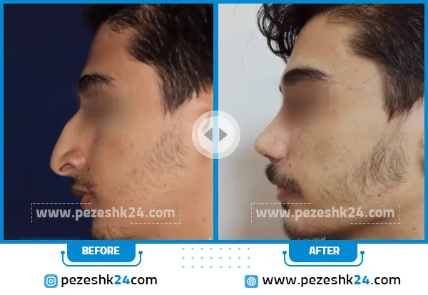 قبل و بعد عمل بینی دکتر توکلی قزوین