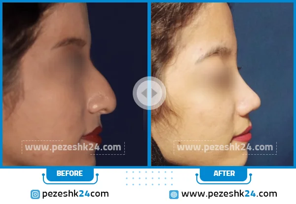 قبل و بعد جراحی بینی دکتر توکلی