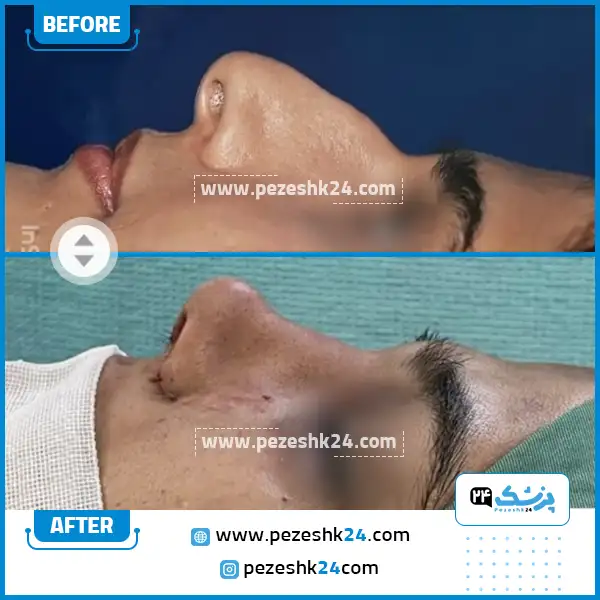 قبل و بعد رینوپلاستی دکتر توکلی قزوین