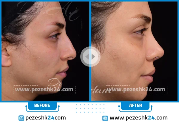قبل و بعد عمل بینی گوشتی دکتر جاودانی