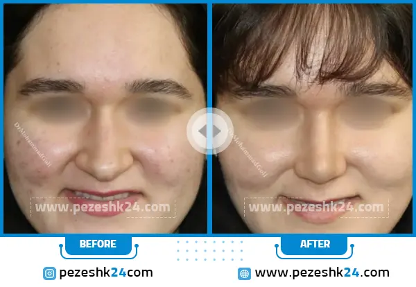 قبل و بعد رینوپلاستی دکتر محمد گلی قزوین