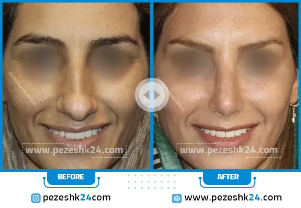 قبل و بعد رینوپلاستی دکتر محمد گلی