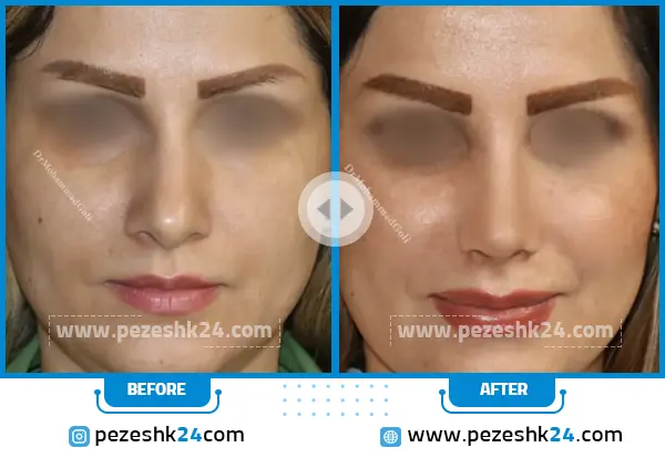 قبل و بعد عمل بینی دکتر گلی قزوین
