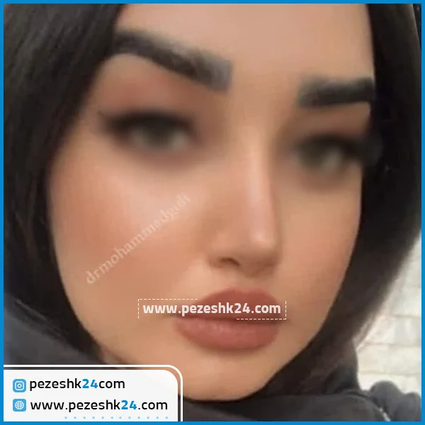 نمونه جراحی بینی دکتر محمد گلی قزوین