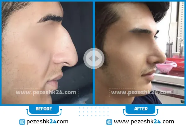 قبل و بعد رنیوپلاستی دکتر مهدیس اصفهانی