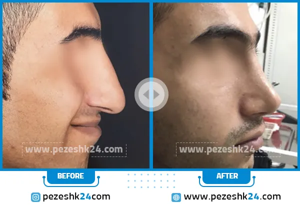 قبل و بعد رنیوپلاستی دکتر اصفهانی