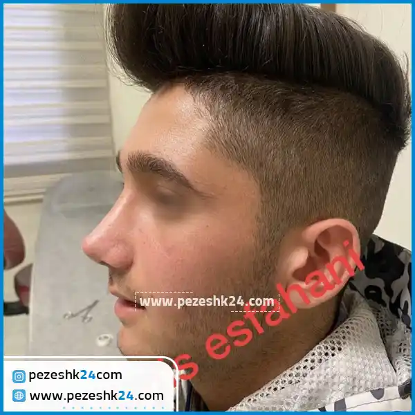 نمونه جراحی بینی دکتر اصفهانی قزوین