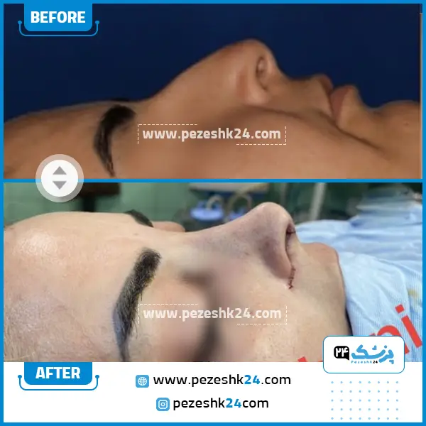 قبل و بعد عمل بینی دکتر اصفهانی قزوین