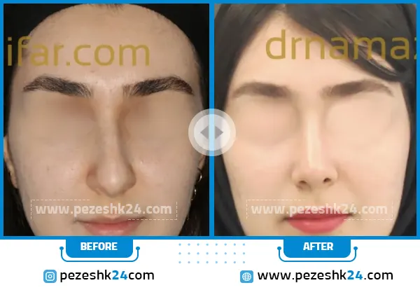قبل و بعد جراحی بینی دکتر مجید نمازی فر