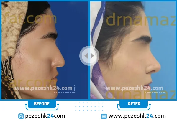 قبل و بعدرینوپلاستی دکتر نمازی فر
