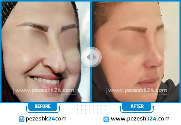 قبل و بعد عمل بینی دکتر صفدریان