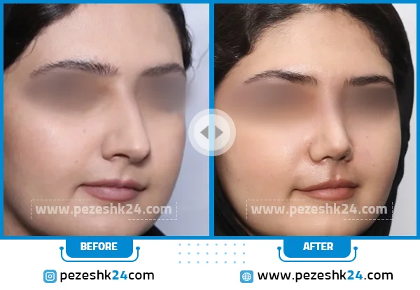 قبل و بعد جراحی بینی دکتر صفدریان