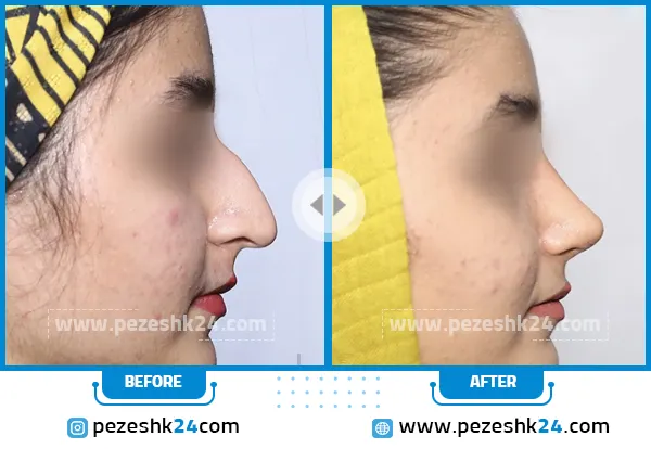 قبل و بعد رینوپلاستی دکتر صفدریان