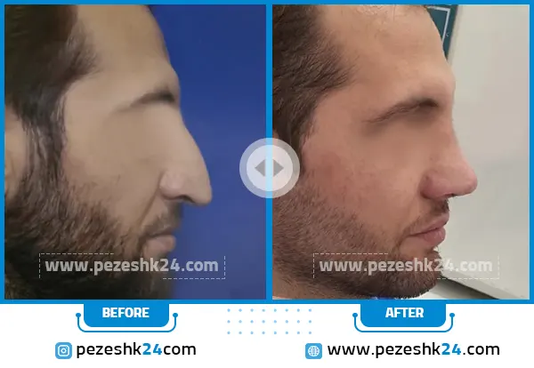 قبل و بعد عمل بینی دکتر صفدریان قزوین