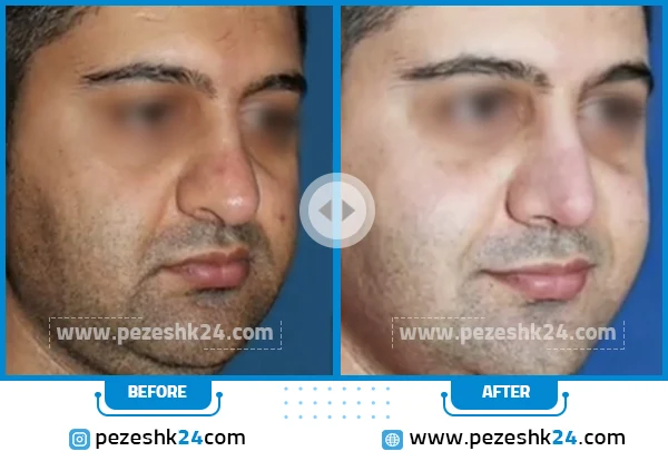 قبل و بعد عمل بینی دکتر سام تویسرکانی