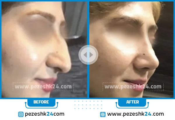 قبل و بعد رینوپلاستی دکتر ابراهیمی