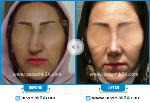 قبل و بعد عمل بینی دکتر ابراهیمی قزوین