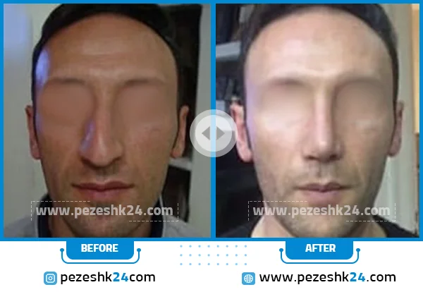 قبل و بعد جراحی بینی دکتر احمد ابراهیمی