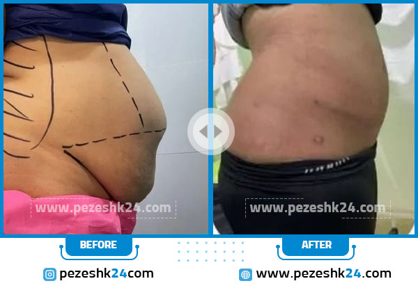 قبل و بعد پیکرتراشی دکتر مهمان نواز رشت