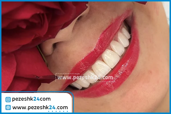 عکس کامپوزیت دندان جلو